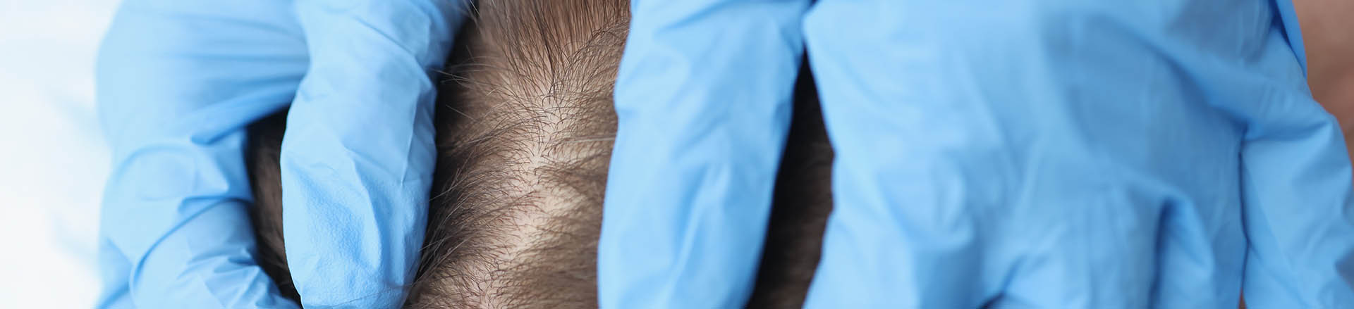fue and fut hair transplant