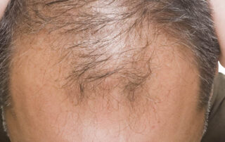 Norwood Scale For Mens Hair Loss
