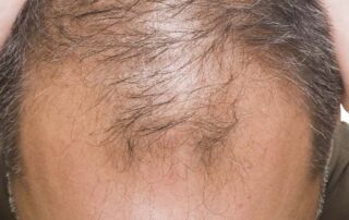 Can PRP help stop hair loss