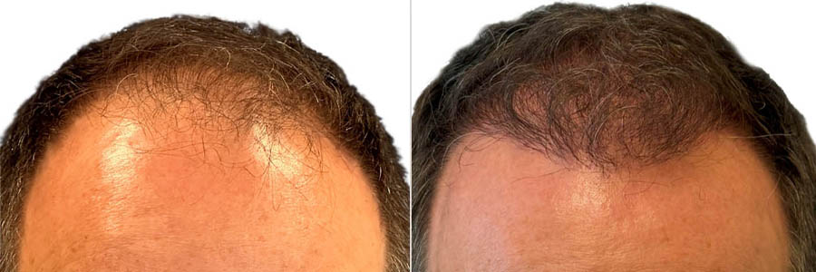 male hair transplant