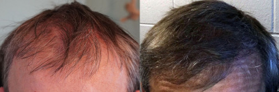 Male FUE Hair Transplant