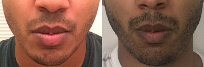 Male FUT Facial Hair Transplant