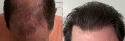 Male FUE Hair Transplant