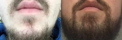 Male FUT Facial Hair Transplant